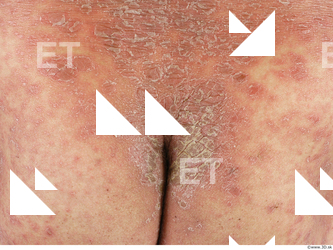 photo texture of scarred skin 0004