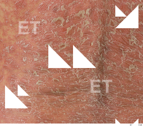 photo texture of scarred skin 0003