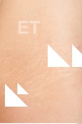 photo texture of scarred skin 0009